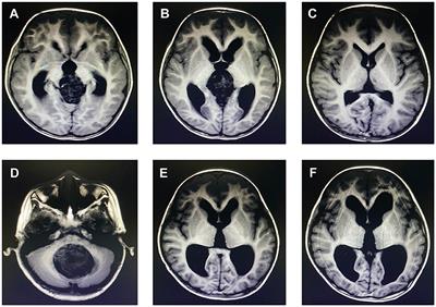 Predictive factors for persistent postoperative hydrocephalus in children undergoing surgical resection of periventricular tumors